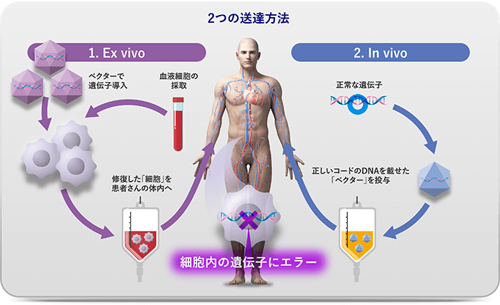 2つの送達方法 1.Ex vivo:血液細胞の採取->ベクターで遺伝子挿入->修復した「細胞」を患者さんの体内へ 2.In vivo:正常な遺伝子->正しいコードのDNAを載せた「ベクター」を投与 細胞内の遺伝子にエラー